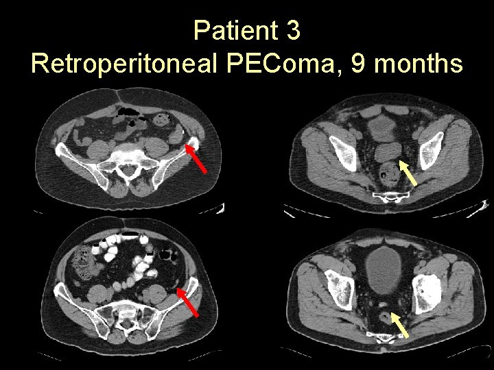 Patient 3 Retroperitoneal PEComa, 9 months 