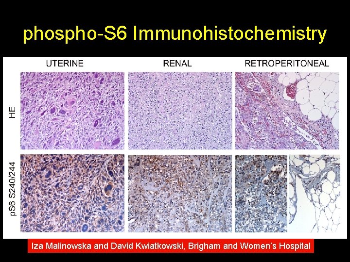 phospho-S 6 Immunohistochemistry Iza Malinowska and David Kwiatkowski, Brigham and Women’s Hospital 