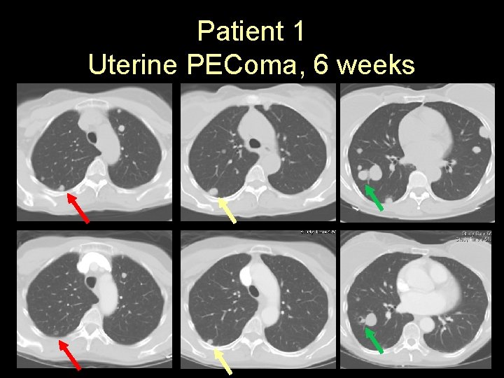 Patient 1 Uterine PEComa, 6 weeks 