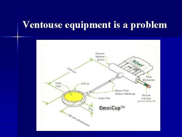 Ventouse equipment is a problem 