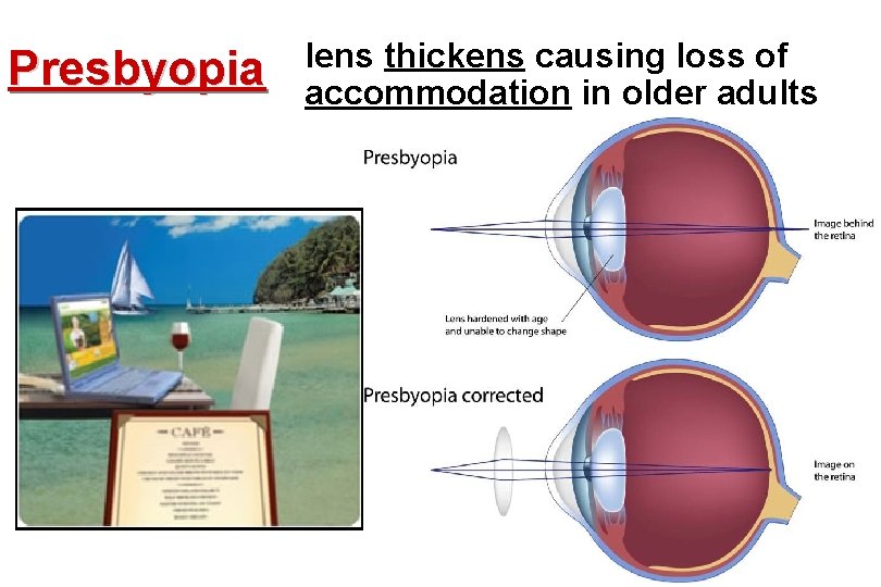 Presbyopia lens thickens causing loss of accommodation in older adults 
