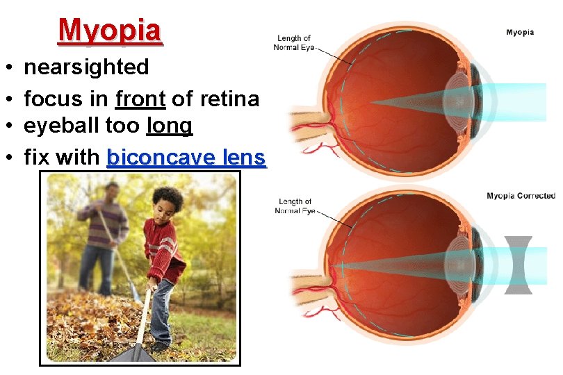 Myopia • • nearsighted focus in front of retina eyeball too long fix with