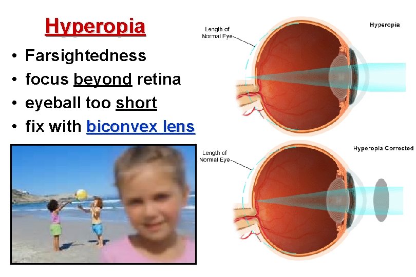 Hyperopia • • Farsightedness focus beyond retina eyeball too short fix with biconvex lens