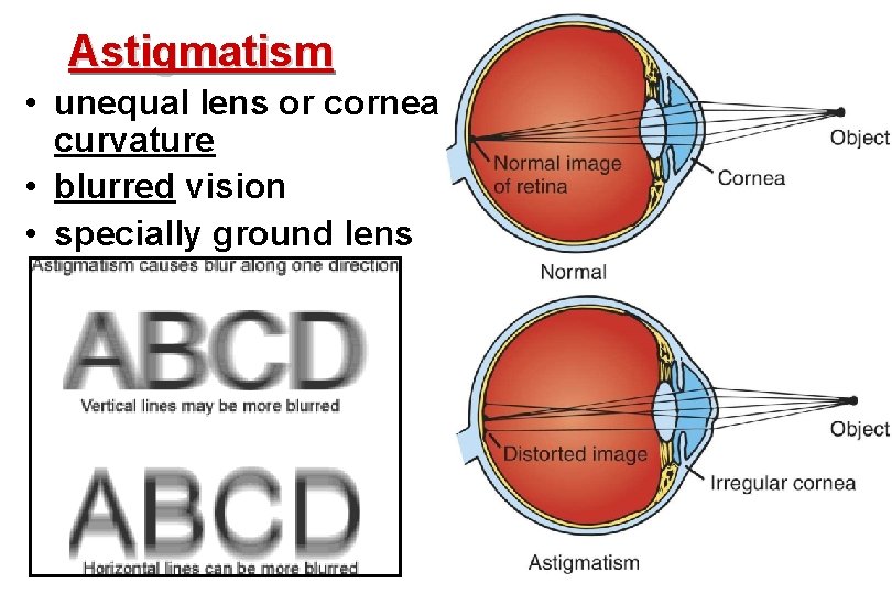 Astigmatism • unequal lens or cornea curvature • blurred vision • specially ground lens