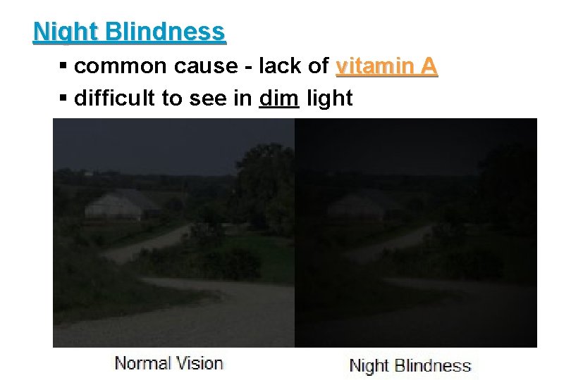 Night Blindness § common cause - lack of vitamin A § difficult to see
