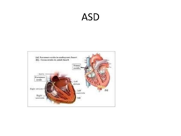 ASD 