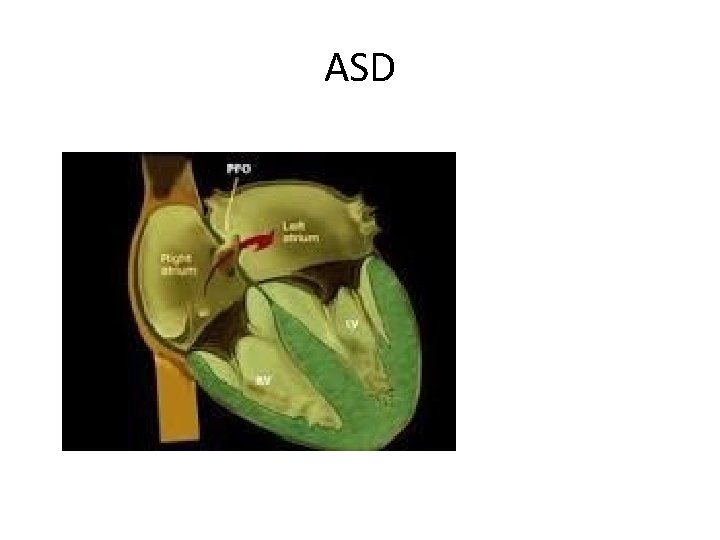 ASD 