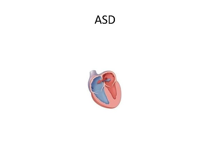 ASD 