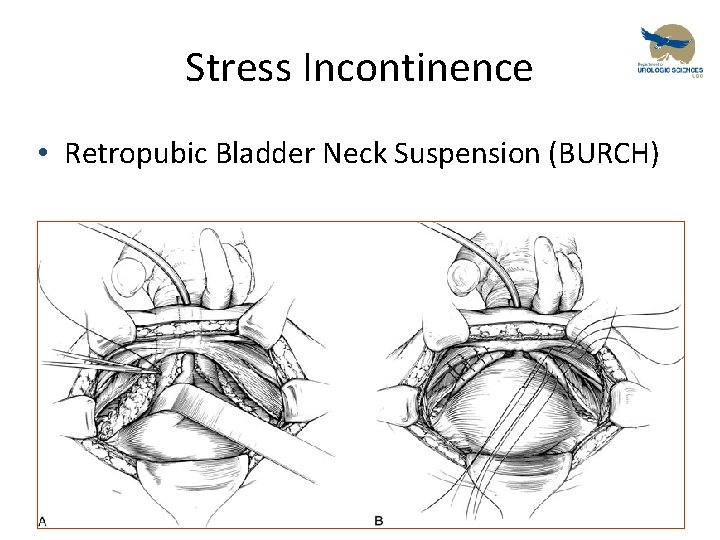 Stress Incontinence • Retropubic Bladder Neck Suspension (BURCH) 