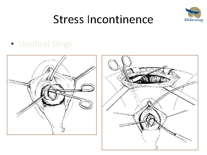 Stress Incontinence • Urethral Slings 