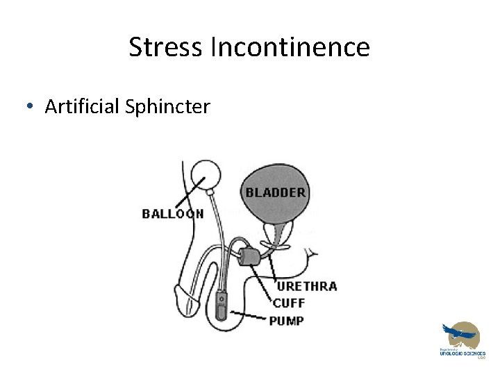 Stress Incontinence • Artificial Sphincter 