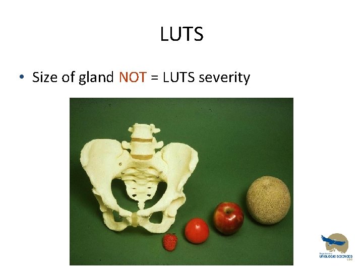 LUTS • Size of gland NOT = LUTS severity 