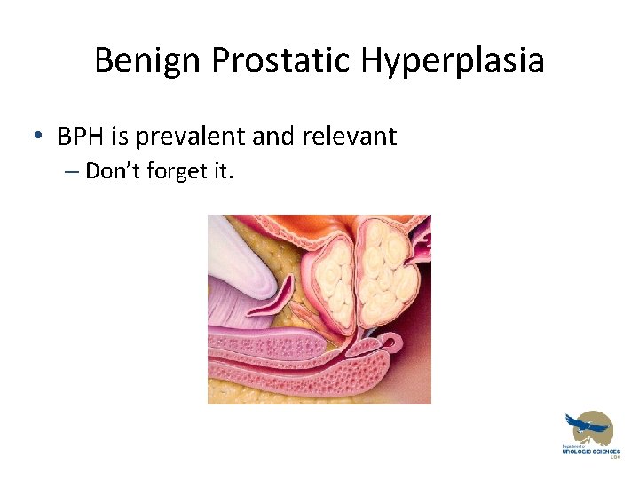 Benign Prostatic Hyperplasia • BPH is prevalent and relevant – Don’t forget it. 