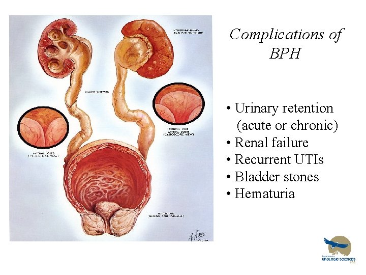 Complications of BPH • Urinary retention (acute or chronic) • Renal failure • Recurrent