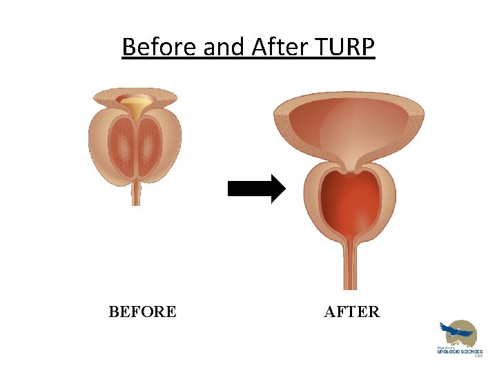 Before and After TURP BEFORE AFTER 