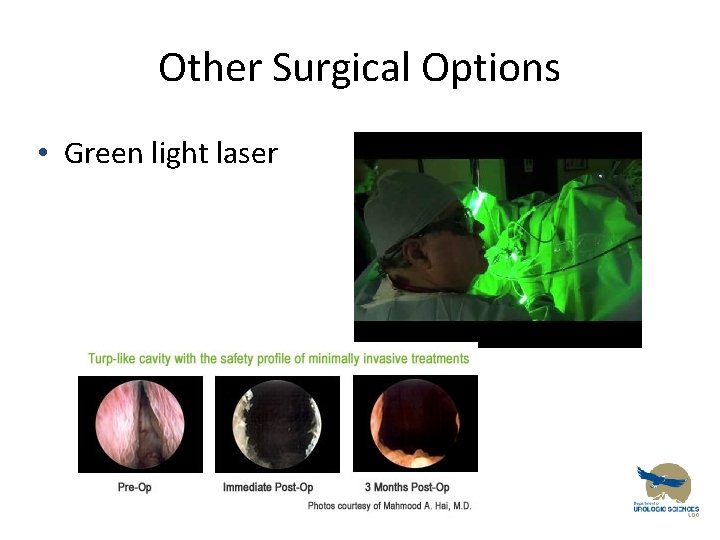 Other Surgical Options • Green light laser 