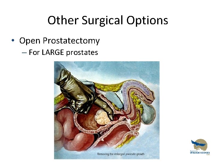 Other Surgical Options • Open Prostatectomy – For LARGE prostates 