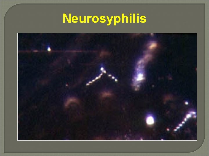 Neurosyphilis 