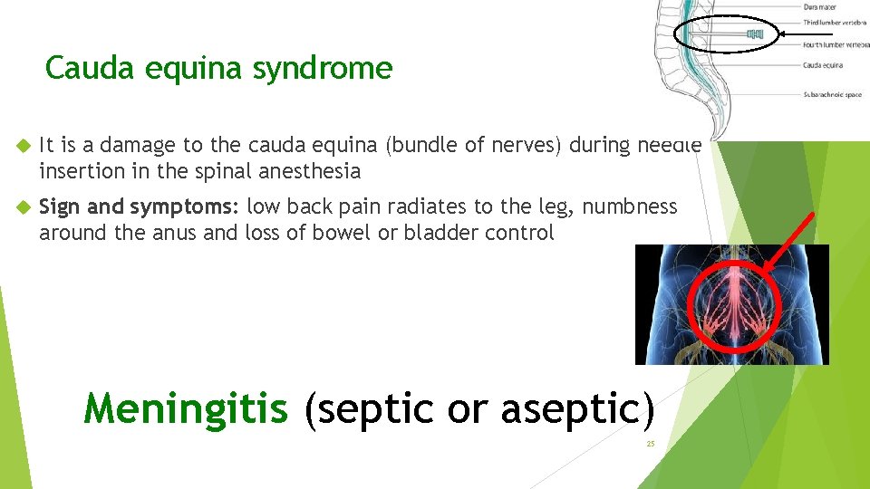 Cauda equina syndrome It is a damage to the cauda equina (bundle of nerves)