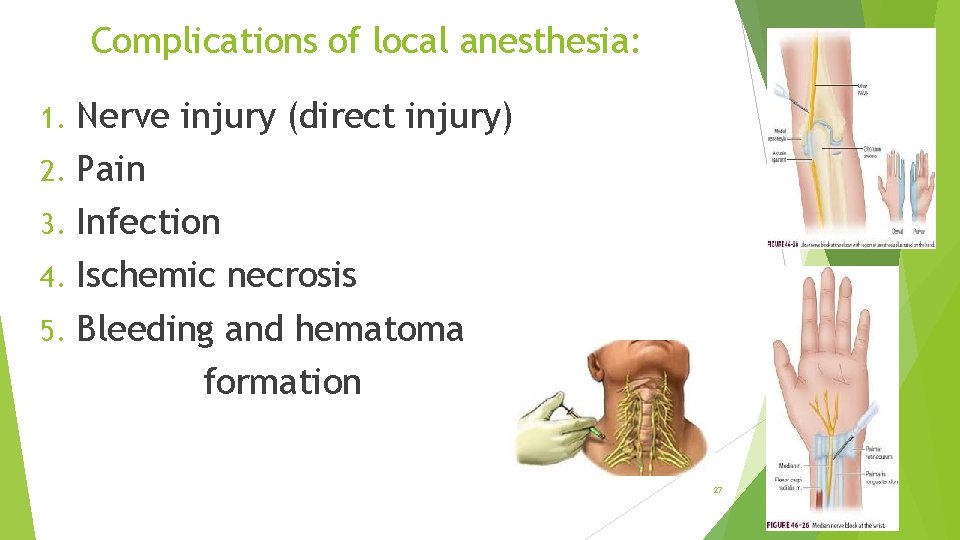 Complications of local anesthesia: Nerve injury (direct injury) 2. Pain 3. Infection 4. Ischemic