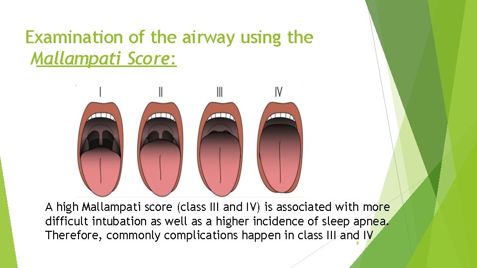 Examination of the airway using the Mallampati Score: A high Mallampati score (class III