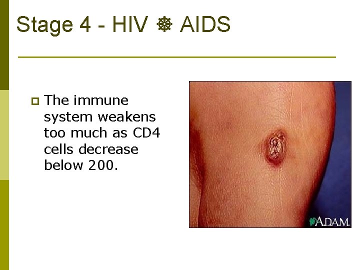 Stage 4 - HIV AIDS p The immune system weakens too much as CD