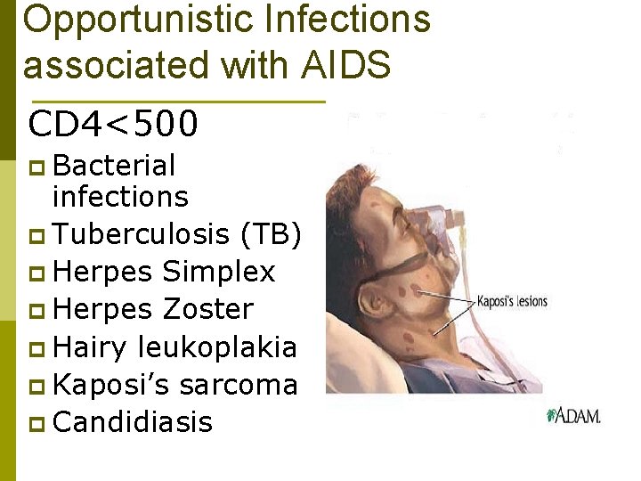 Opportunistic Infections associated with AIDS CD 4<500 p Bacterial infections p Tuberculosis (TB) p