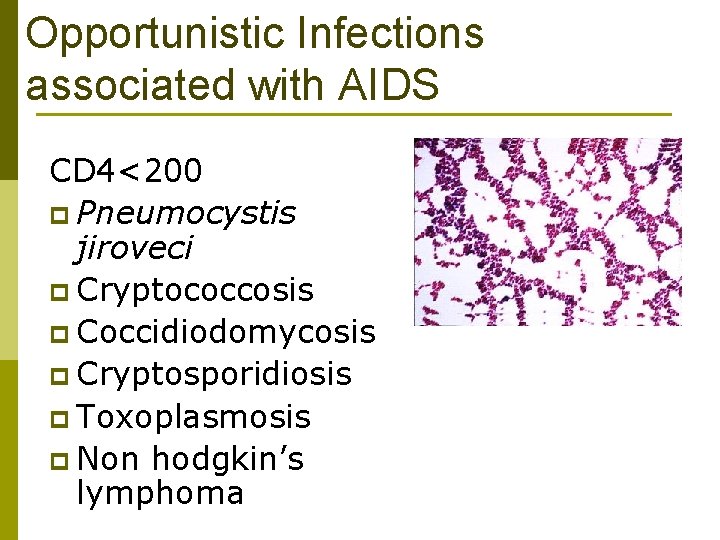 Opportunistic Infections associated with AIDS CD 4<200 p Pneumocystis jiroveci p Cryptococcosis p Coccidiodomycosis