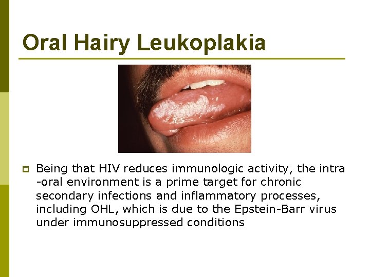 Oral Hairy Leukoplakia p Being that HIV reduces immunologic activity, the intra -oral environment
