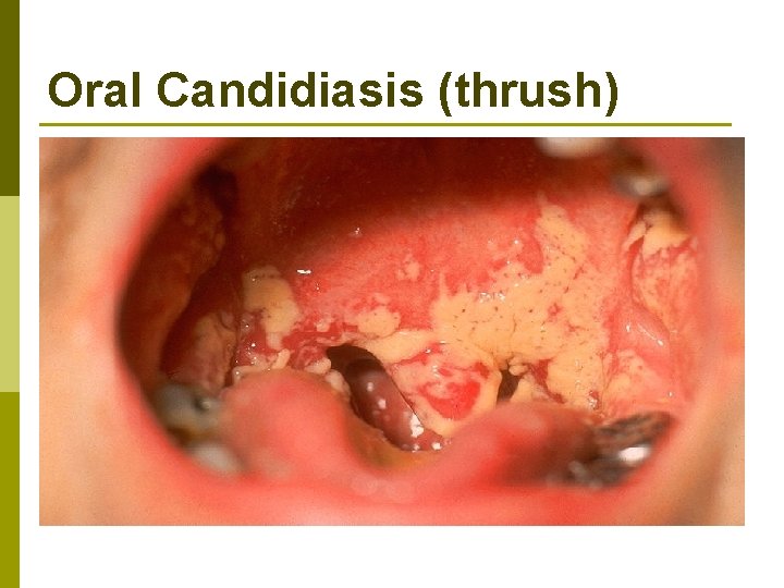 Oral Candidiasis (thrush) 