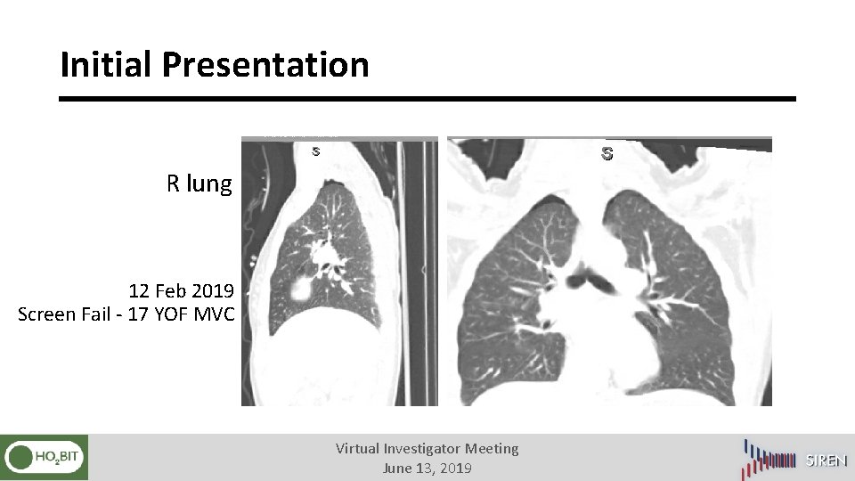 Initial Presentation R lung 12 Feb 2019 Screen Fail - 17 YOF MVC Virtual