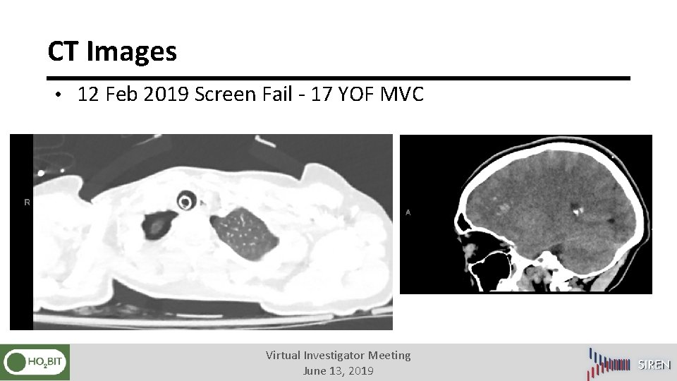CT Images • 12 Feb 2019 Screen Fail - 17 YOF MVC Virtual Investigator