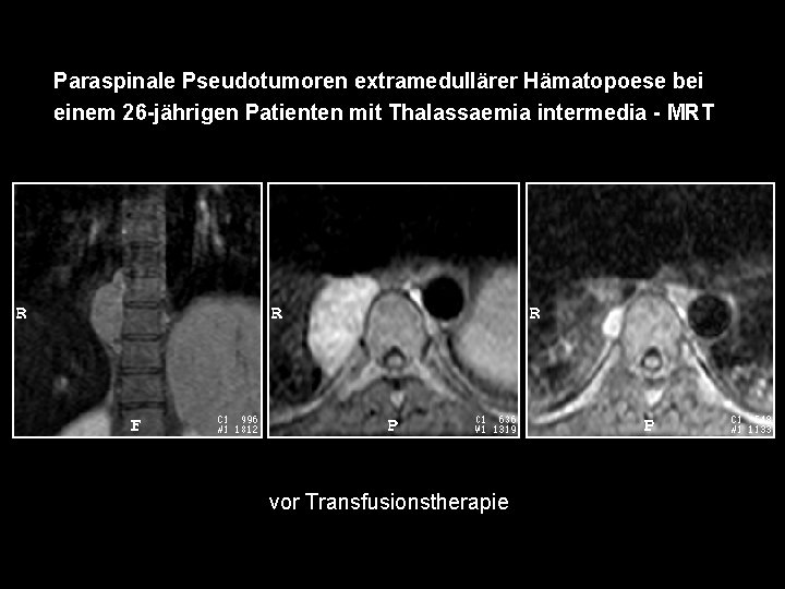 Paraspinale Pseudotumoren extramedullärer Hämatopoese bei einem 26 -jährigen Patienten mit Thalassaemia intermedia - MRT