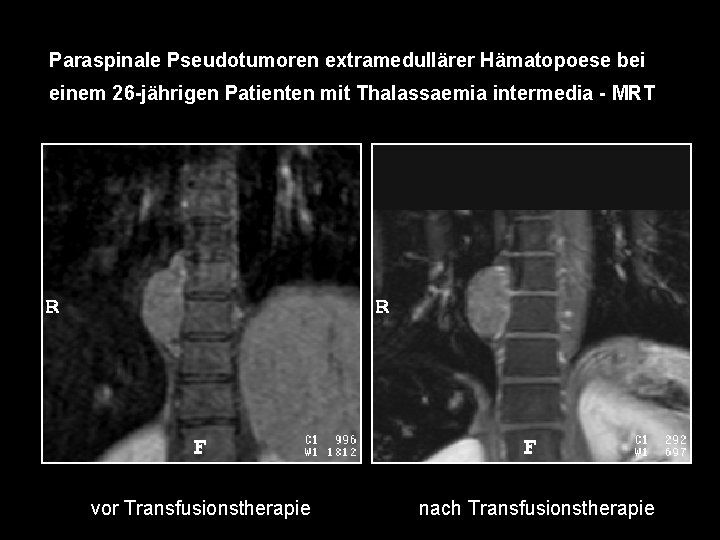 Paraspinale Pseudotumoren extramedullärer Hämatopoese bei einem 26 -jährigen Patienten mit Thalassaemia intermedia - MRT