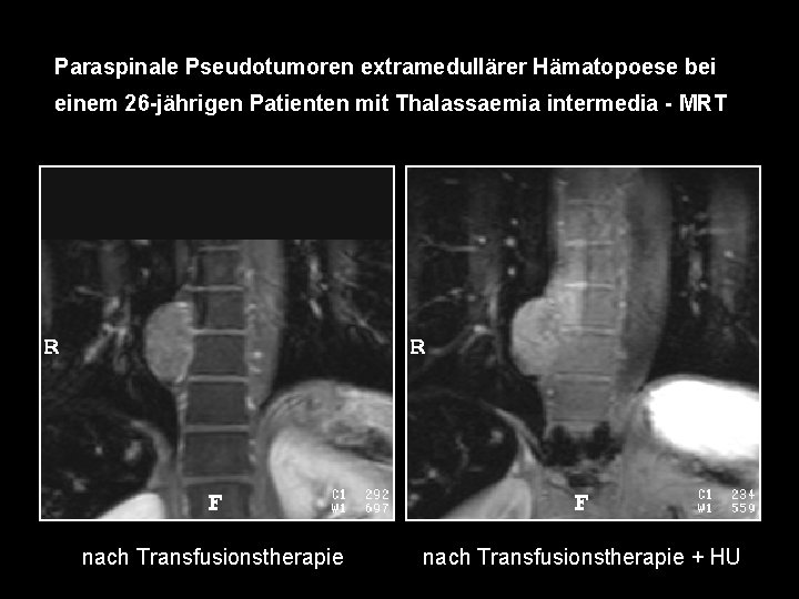 Paraspinale Pseudotumoren extramedullärer Hämatopoese bei einem 26 -jährigen Patienten mit Thalassaemia intermedia - MRT