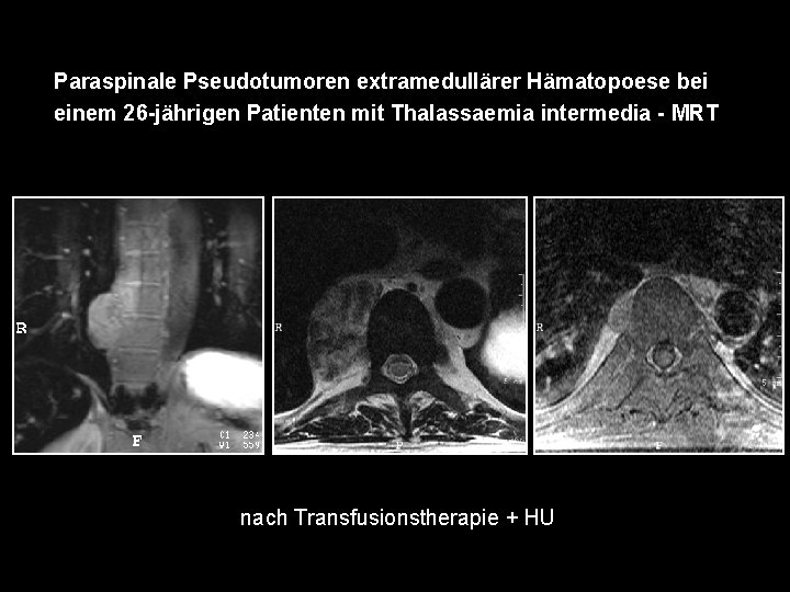 Paraspinale Pseudotumoren extramedullärer Hämatopoese bei einem 26 -jährigen Patienten mit Thalassaemia intermedia - MRT