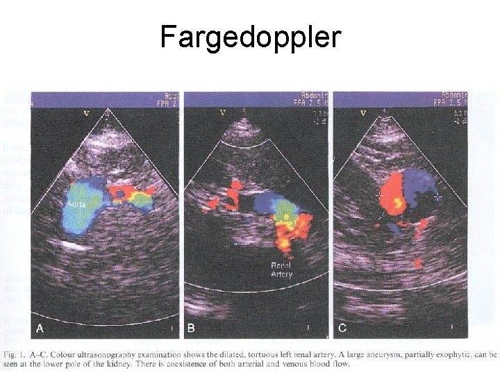 Fargedoppler 72 Fysisk institutt - Rikshospitalet 