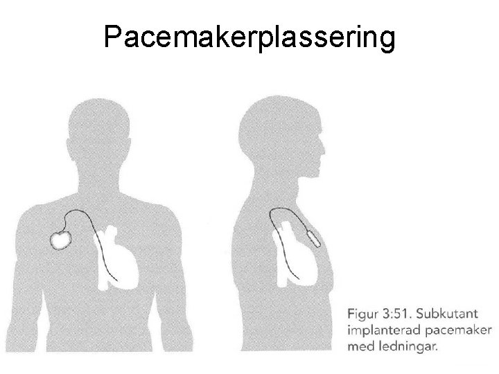 Pacemakerplassering 78 Fysisk institutt - Rikshospitalet 