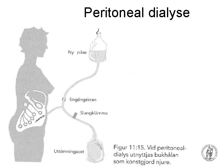 Peritoneal dialyse 81 Fysisk institutt - Rikshospitalet 