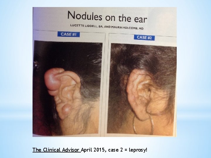 The Clinical Advisor April 2015, case 2 = leprosy! 