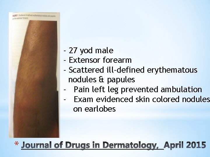 - 27 yod male - Extensor forearm - Scattered ill-defined erythematous nodules & papules