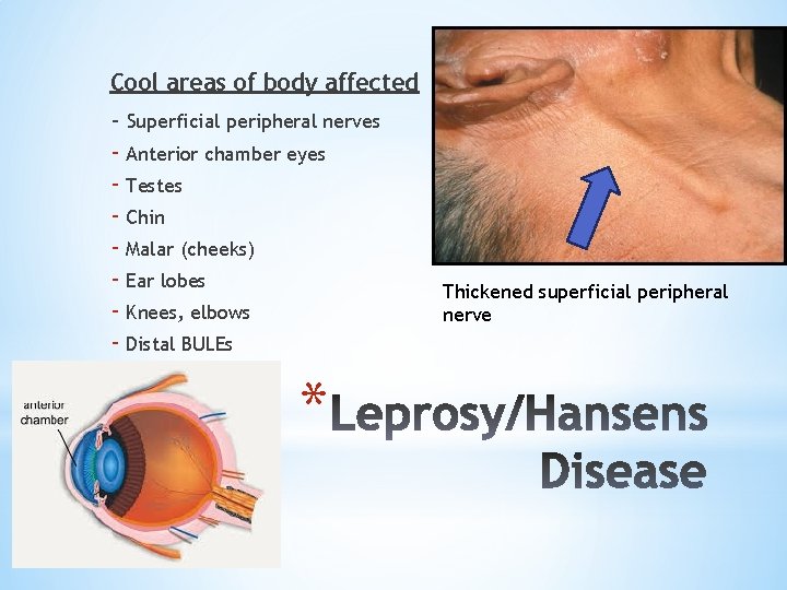 Cool areas of body affected - Superficial peripheral nerves - Anterior chamber eyes -