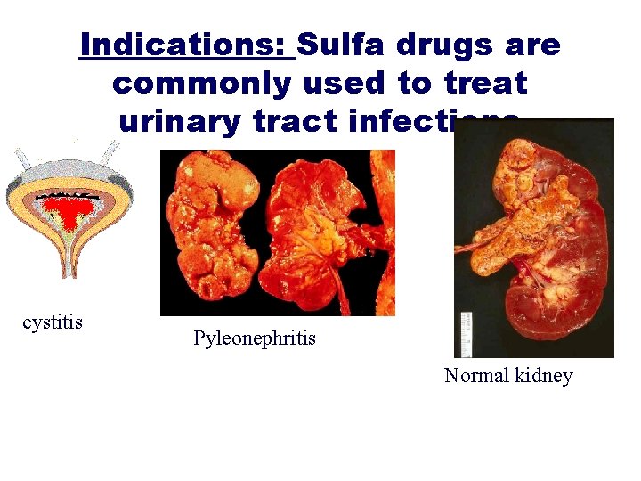 Indications: Sulfa drugs are commonly used to treat urinary tract infections cystitis Pyleonephritis Normal
