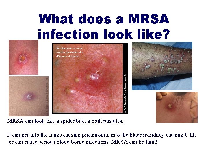 What does a MRSA infection look like? MRSA can look like a spider bite,