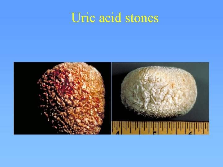 Uric acid stones 