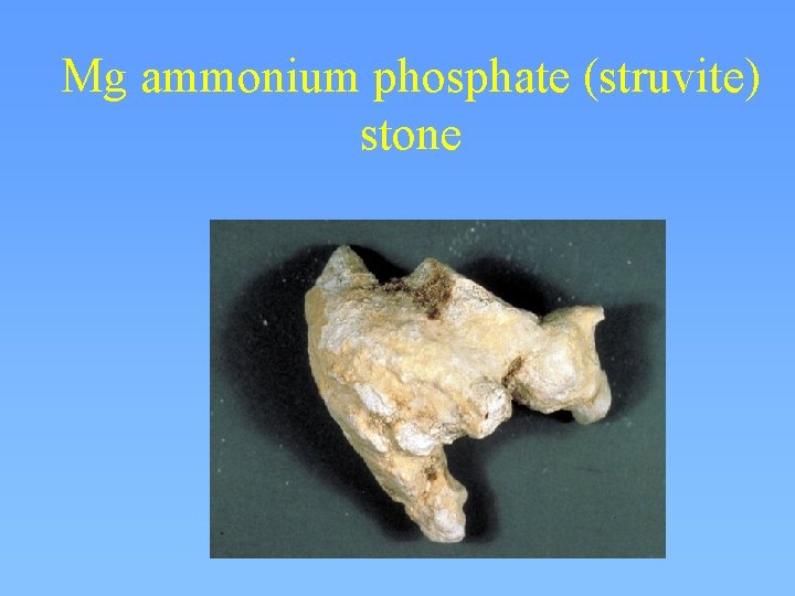 Mg ammonium phosphate (struvite) stone 