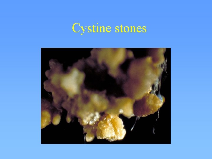 Cystine stones 