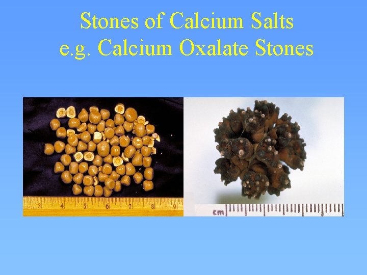 Stones of Calcium Salts e. g. Calcium Oxalate Stones 