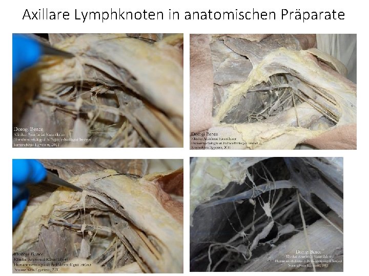 Axillare Lymphknoten in anatomischen Präparate 