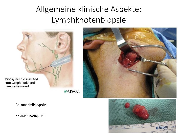 Allgemeine klinische Aspekte: Lymphknotenbiopsie Feinnadelbiopsie Excisionsbiopsie 